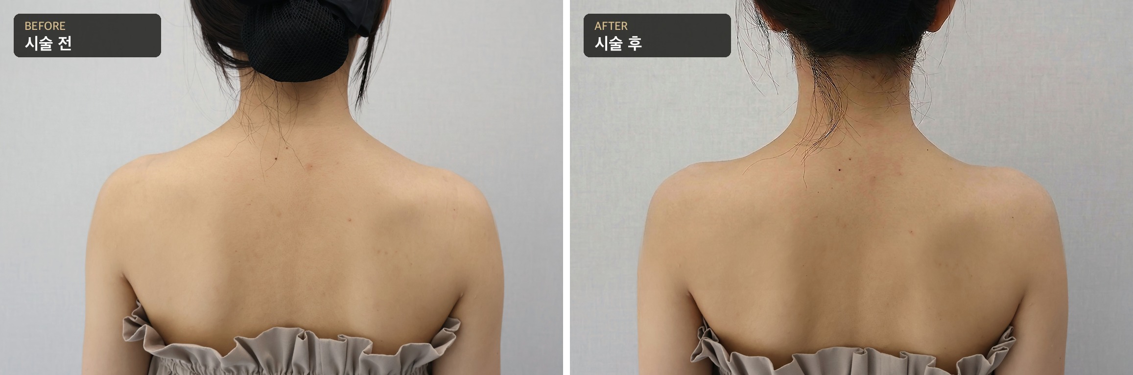 어깨라인 필러 전후 — 뒷모습, 시술 전·후 예시