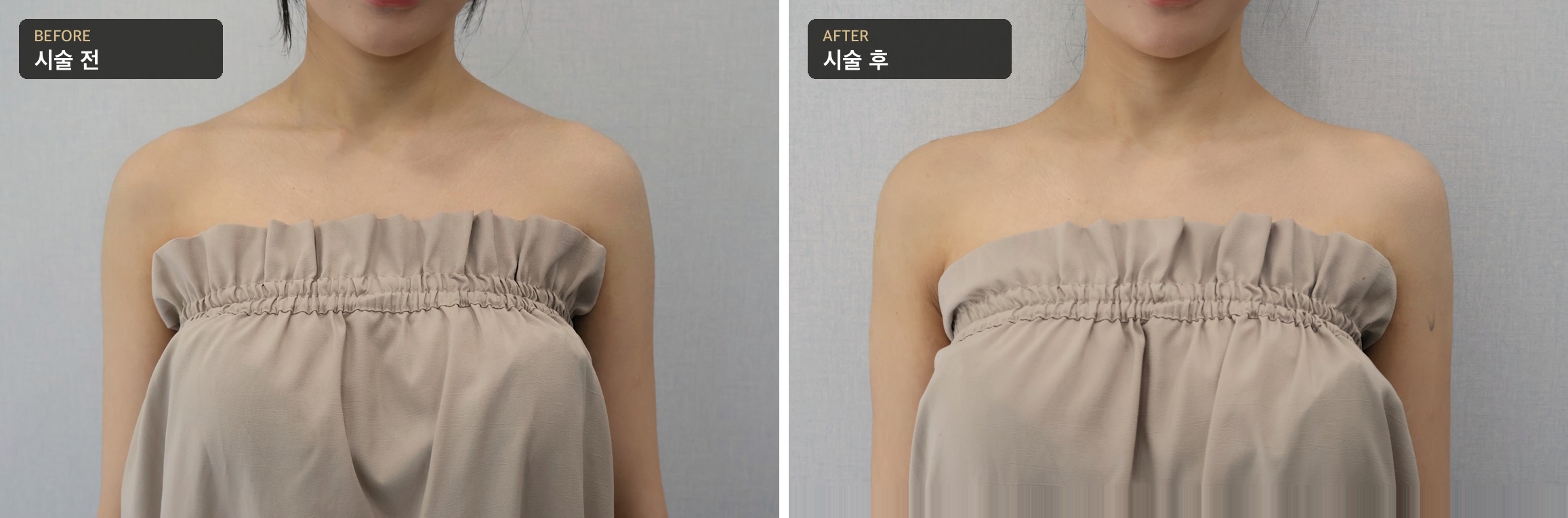 어깨라인 필러 전후 — 정면, 시술 전·후 예시